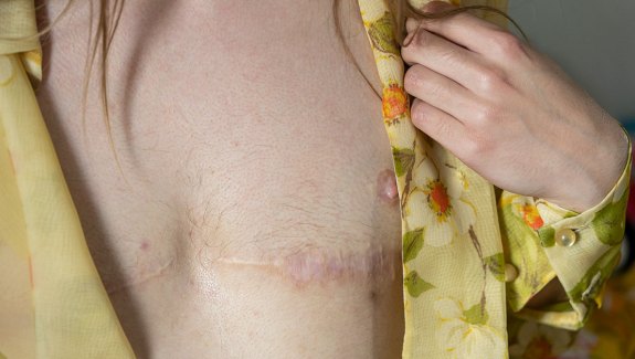 AT LAST: Samuel Kulovitz reveals the scars from his breast removal surgery. After the procedure, “I finally felt right in my body,” he said. REUTERS/Mikala Compton